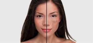 Dark Spots on Skin? It Could Be Melasma