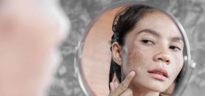 How to Get Rid of Melasma
