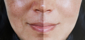 Pynocare 40 Actisome Clinical Study in Thailand