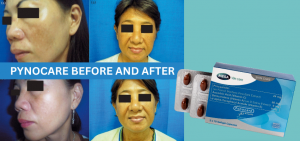 Clinically Proven Solution to Melasma: Pynocare Before and After