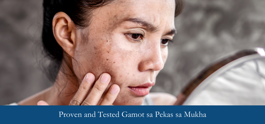 proven and tested gamot sa melasma