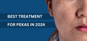 Best Treatment for Pekas in 2024
