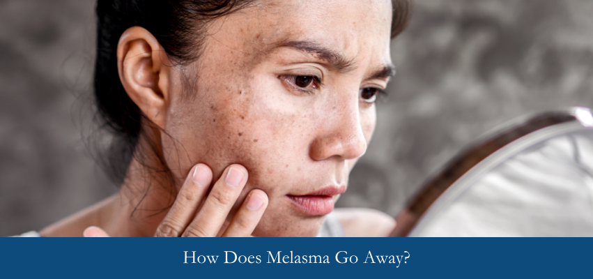 How Does Melasma Go Away?