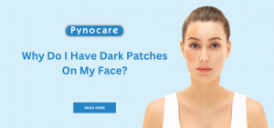 Why Do I Have Dark Patches on My Face? Common Causes and Ways to Care for Your Skin